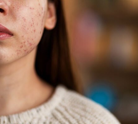 Ayurvedic Treatment For Acne And Pimples