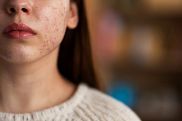 Ayurvedic Treatment For Acne And Pimples Ayurvedic Treatment For Acne And Pimples