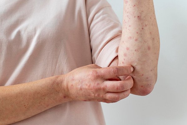 Eczema Treatment Eczema Treatment