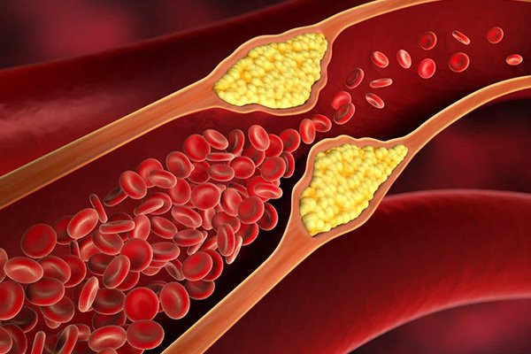 High Cholesterol Treatment