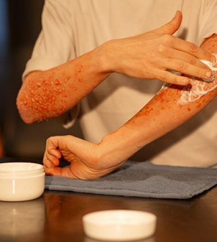 Treatment For Atopic Dermatitis Treatment For Atopic Dermatitis